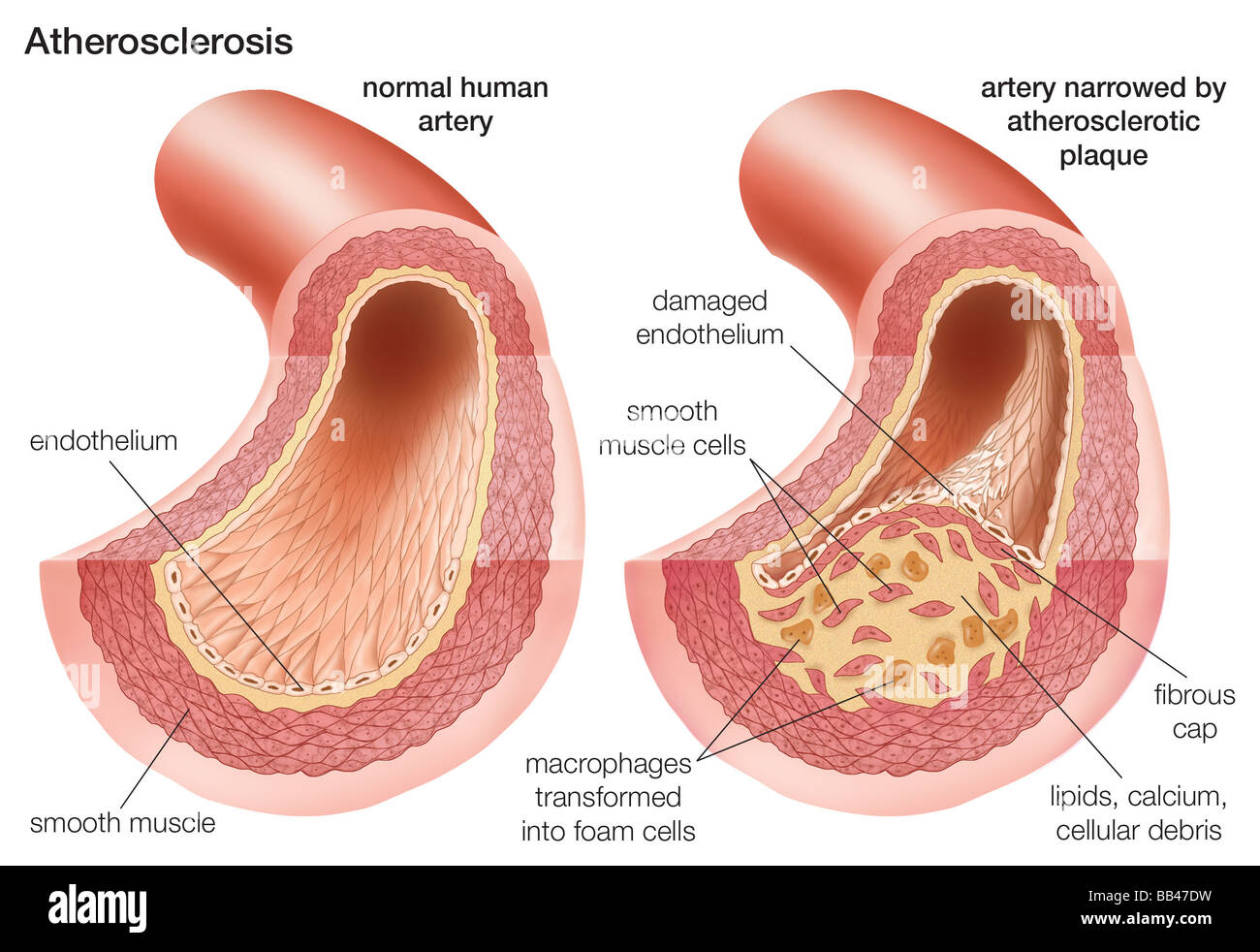 Arteriosklerose: Vergleich einer normalen Arterie mit einer Arterie verengt von atherosklerotischen Plaques Stockfoto