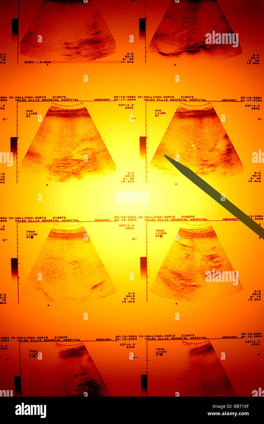 farbcodierte Ultraschall untersucht mit Zeigegerät Stockfoto