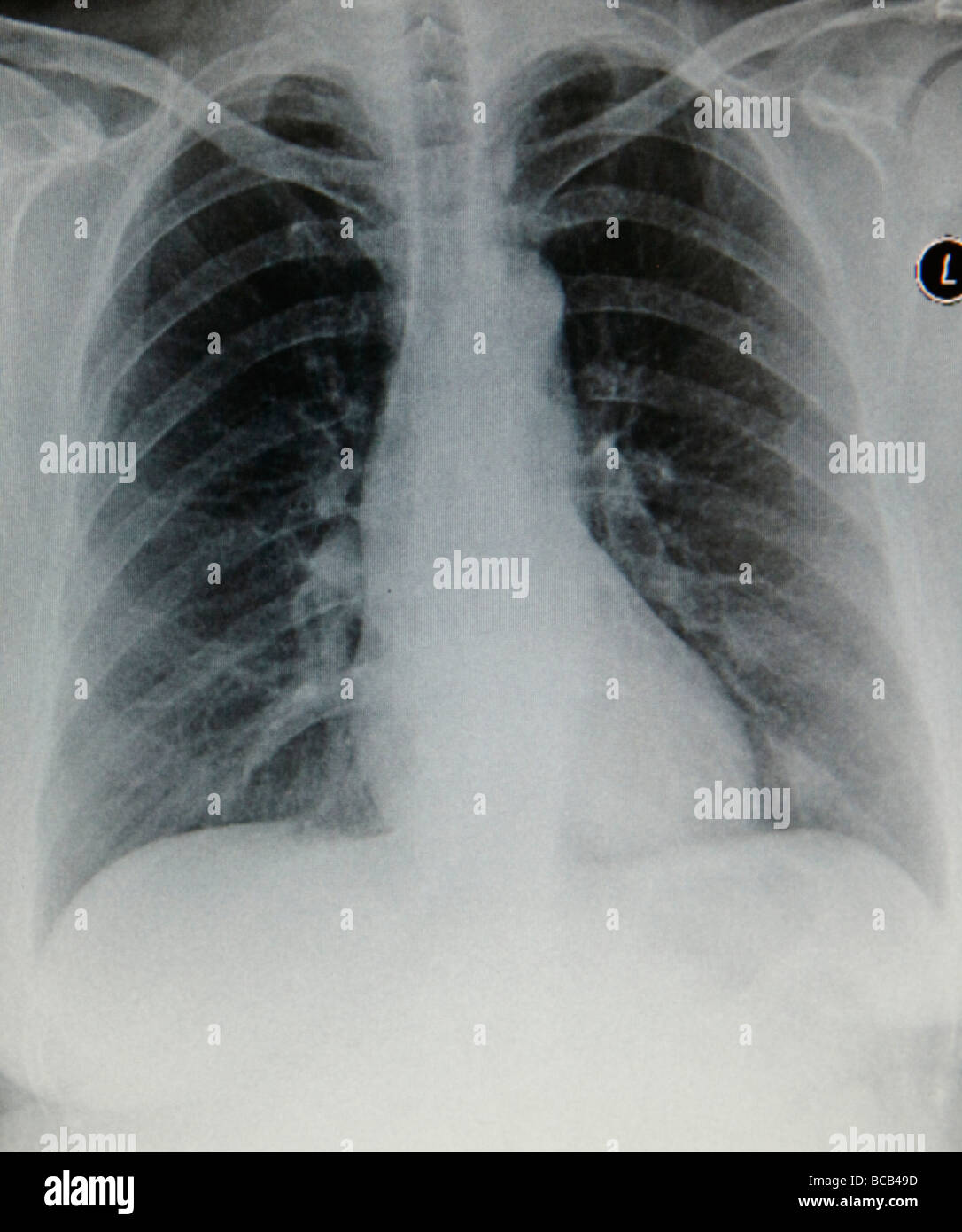 Röntgen-Thorax. Stockfoto