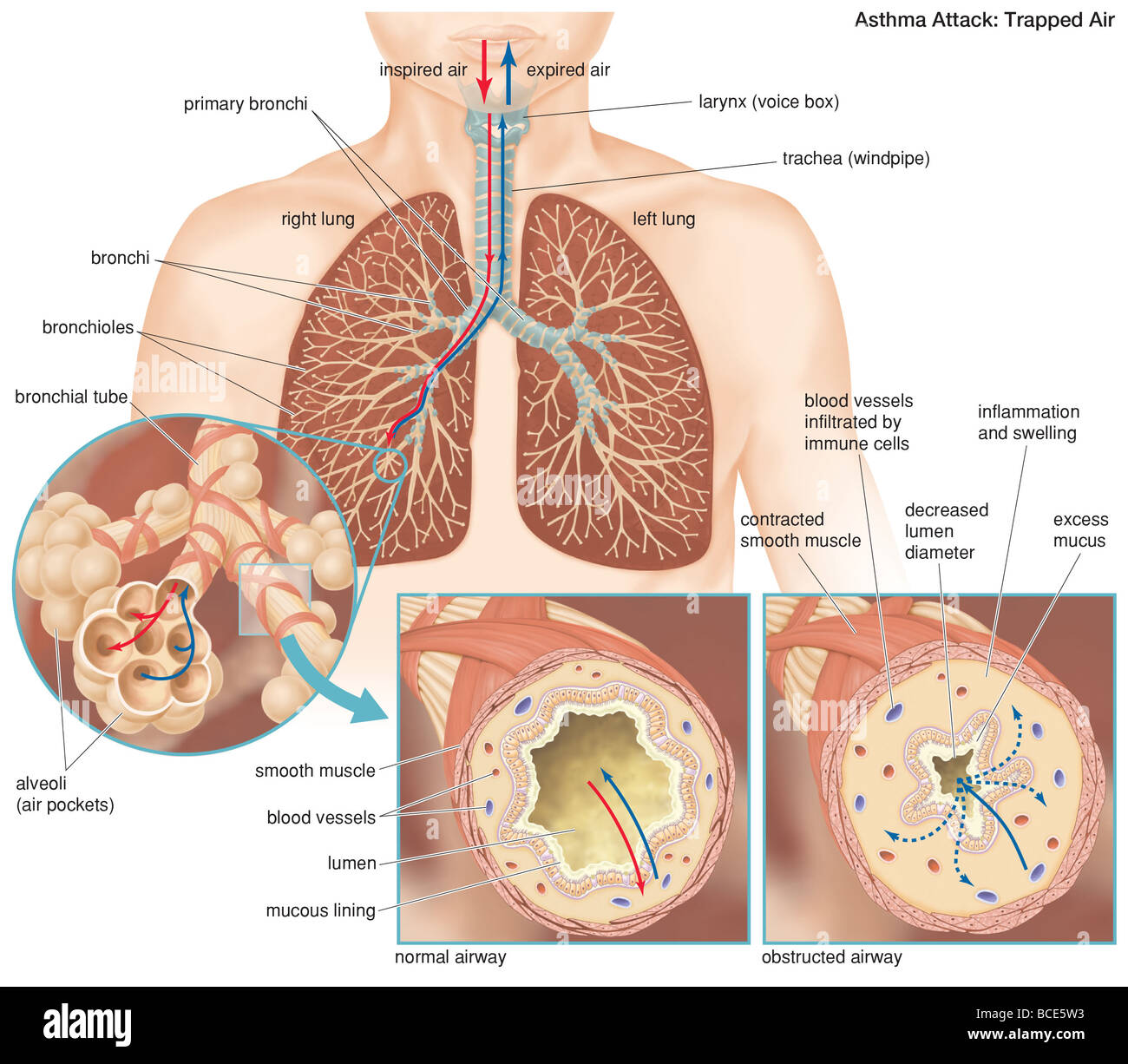 Die Anatomie des einen Asthma-Anfall, demonstriert den Unterschied zwischen einer normalen und einer verstopfte Atemwege. Stockfoto