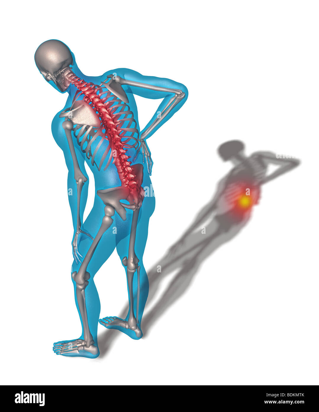 Abbildung mit Rückenschmerzen Stockfoto