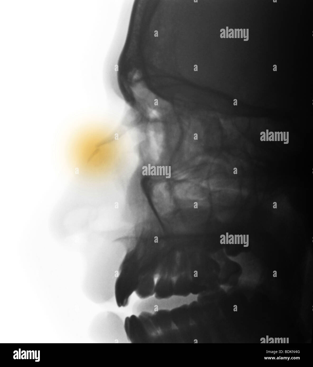 x-ray zeigt einen nasalen Knochenbruch in ein 18 Jahre alter Mann Stockfoto