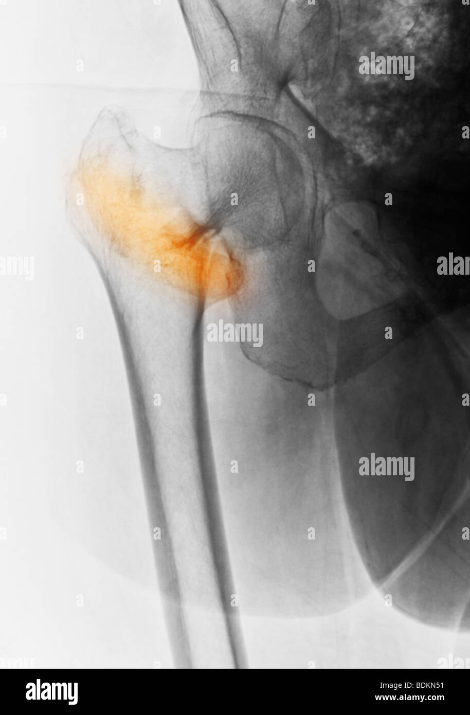 x-ray zeigt eine Hüftfraktur in eine 84 Jahre alte Frau mit Osteoporose Stockfoto