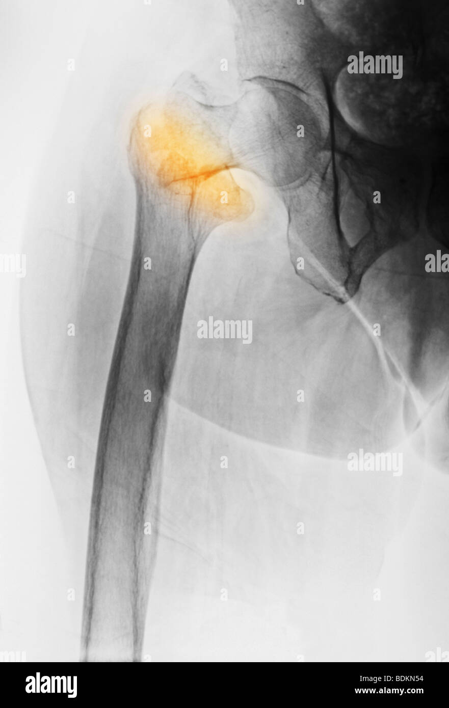 x-ray zeigt eine Hüftfraktur in eine 84 Jahre alte Frau mit Osteoporose Stockfoto