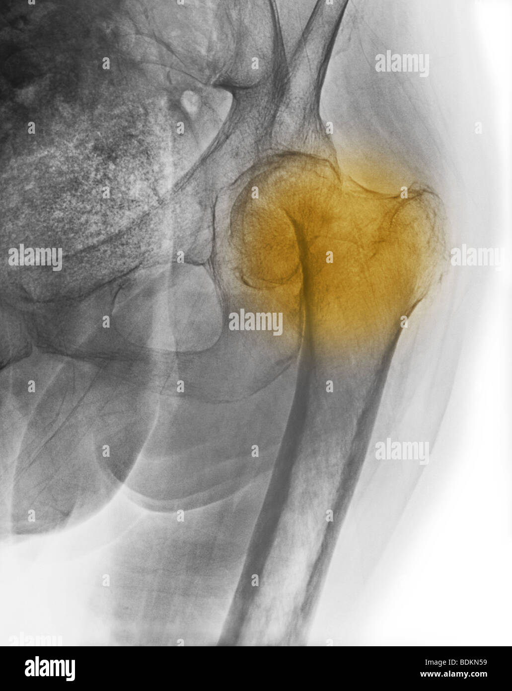 x-ray zeigt eine Hüftfraktur in eine 84 Jahre alte Frau mit Osteoporose Stockfoto