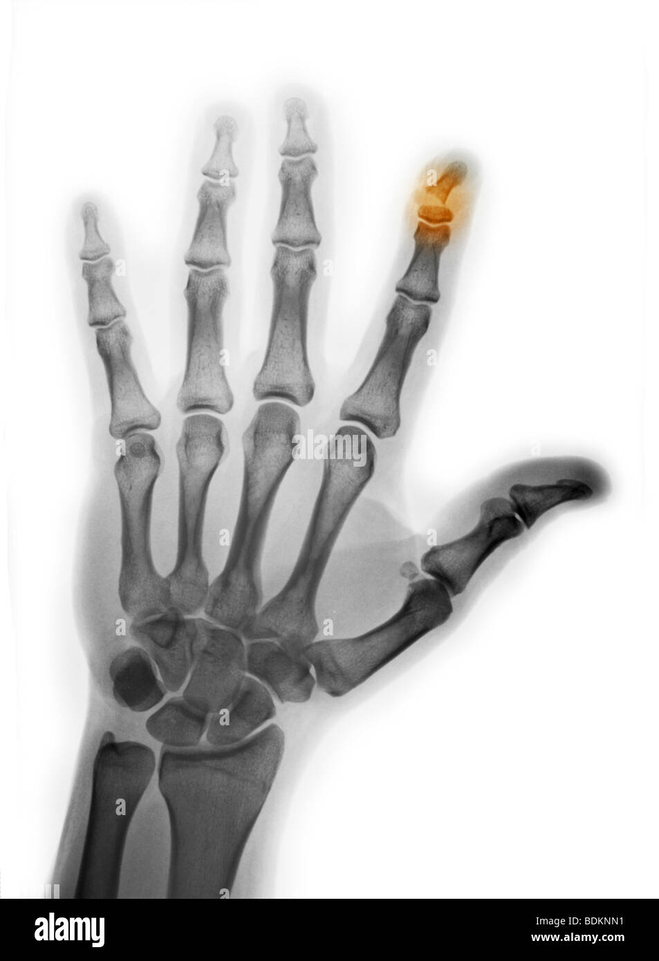 Hand-Röntgenaufnahme zeigt eine Fraktur der distalen Phalanx des Zeigefingers Stockfoto