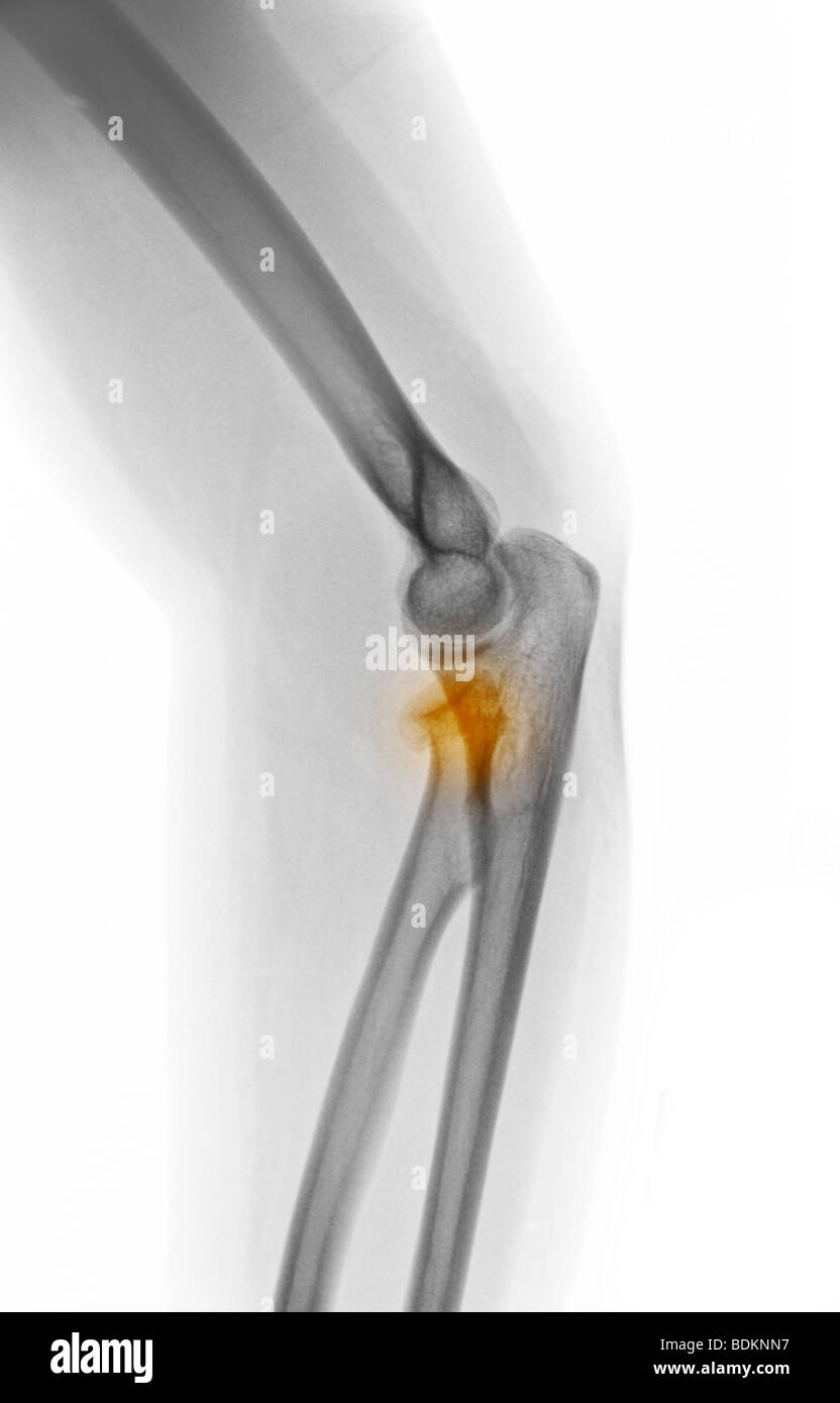 Röntgenbild des Ellenbogens zeigt einen radialen Kopf Bruch in eine 19 Jahre alte Frau Stockfoto