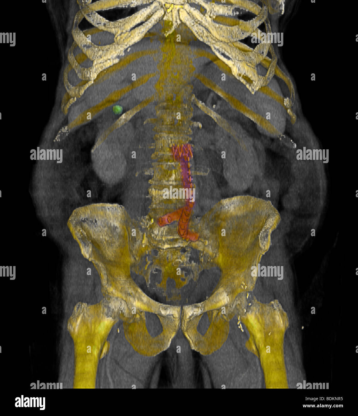 Verbesserte dreidimensionale CT-Scan eines 80 Jahre alten übergewichtige Menschen Farbe. Stockfoto