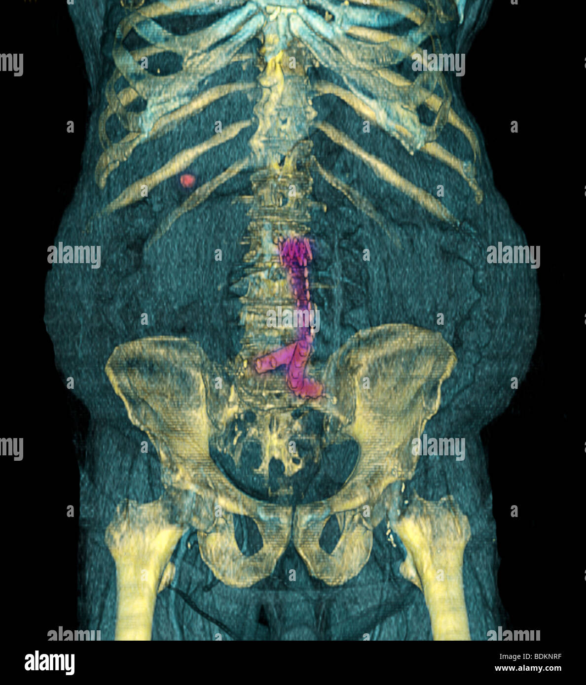 Verbesserte dreidimensionale CT-Scan eines 80 Jahre alten übergewichtige Menschen Farbe. Stockfoto