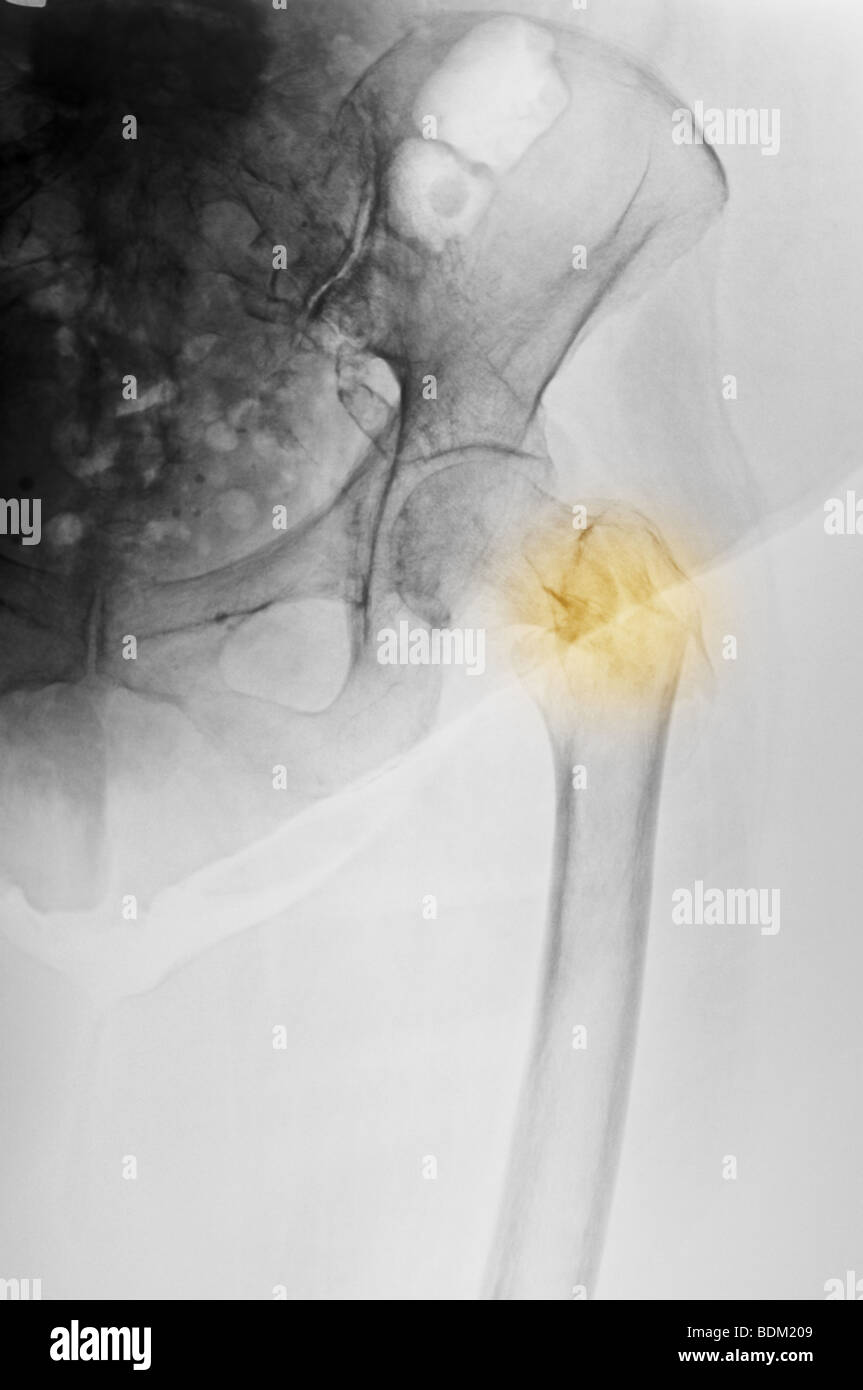 x-ray zeigt eine Hüftfraktur in eine 84 Jahre alte Frau mit Osteoporose Stockfoto