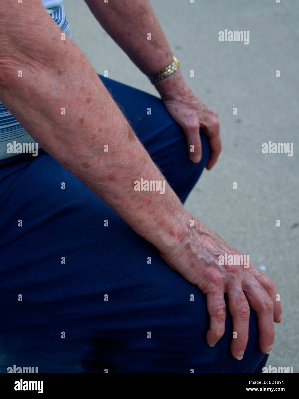 Ältere Frau mit Altersflecken auf Arme und Hände. Stockfoto