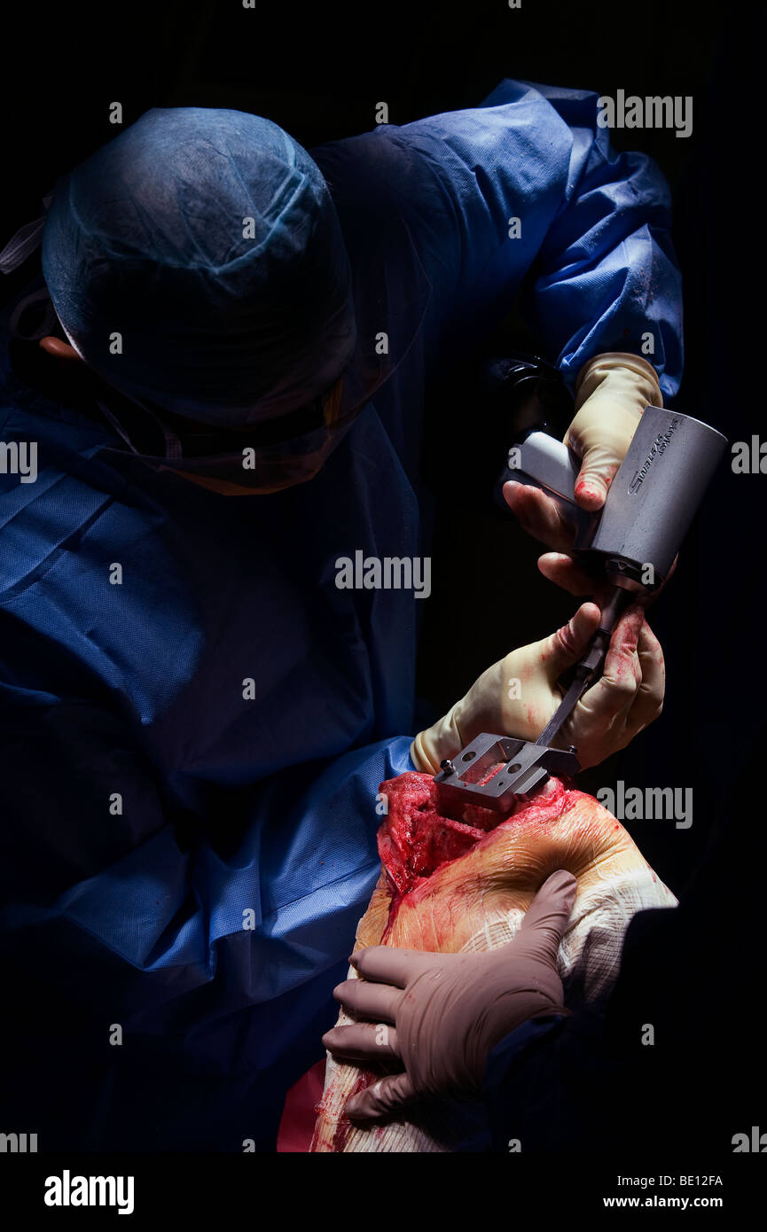 Ein Patient erfährt Kniegelenkersatz-Operationen in einem Krankenhaus West Midlands, nachdem er mit irreparablen Schäden diagnostiziert Stockfoto Ein Patient erfährt Kniegelenkersatz-Operationen in einem Krankenhaus West Midlands, nachdem er mit irreparablen Schäden diagnostiziert Stockfoto