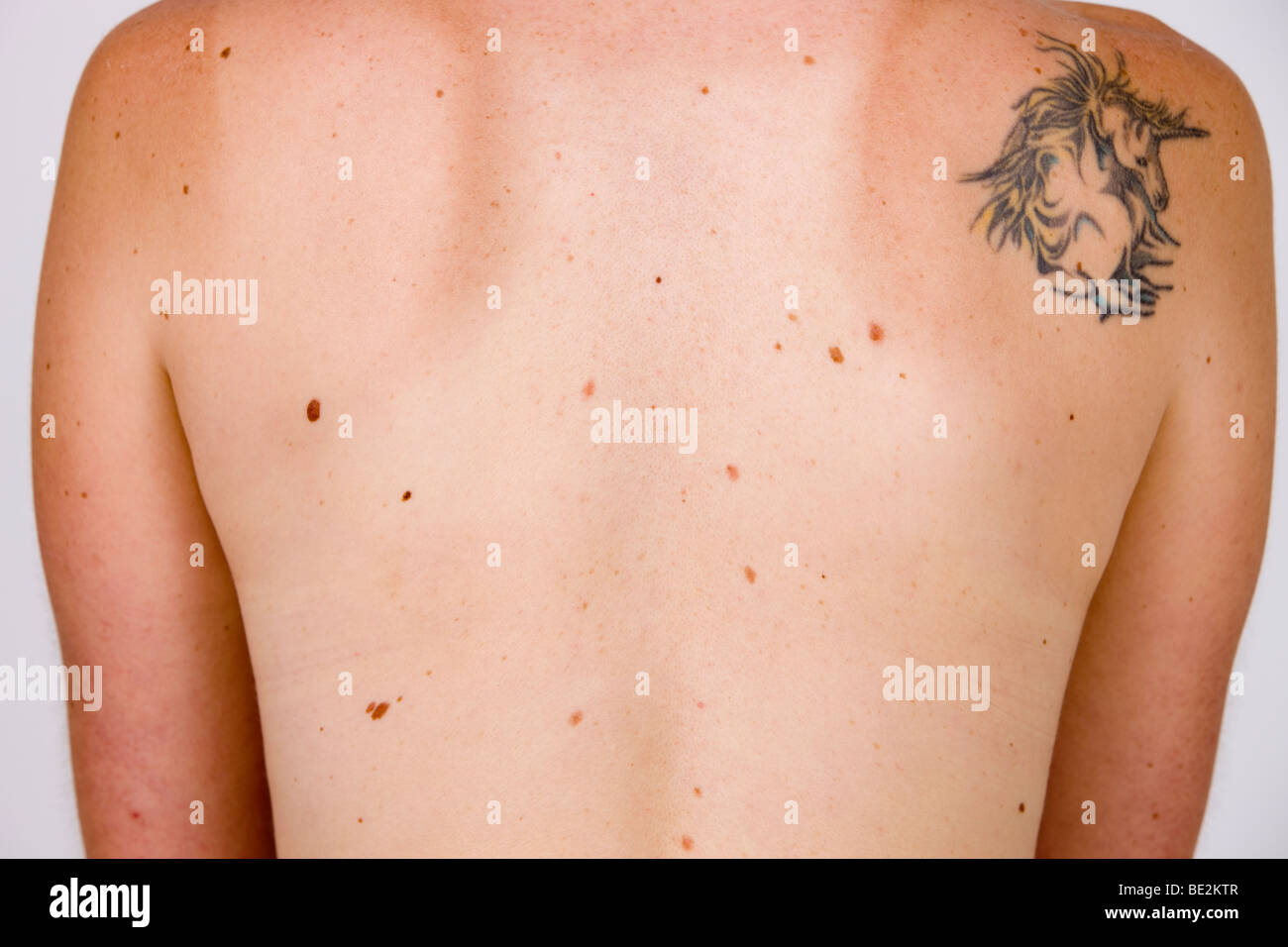 Maulwürfe auf der Rückseite, Hautkrebsrisiko Stockfoto