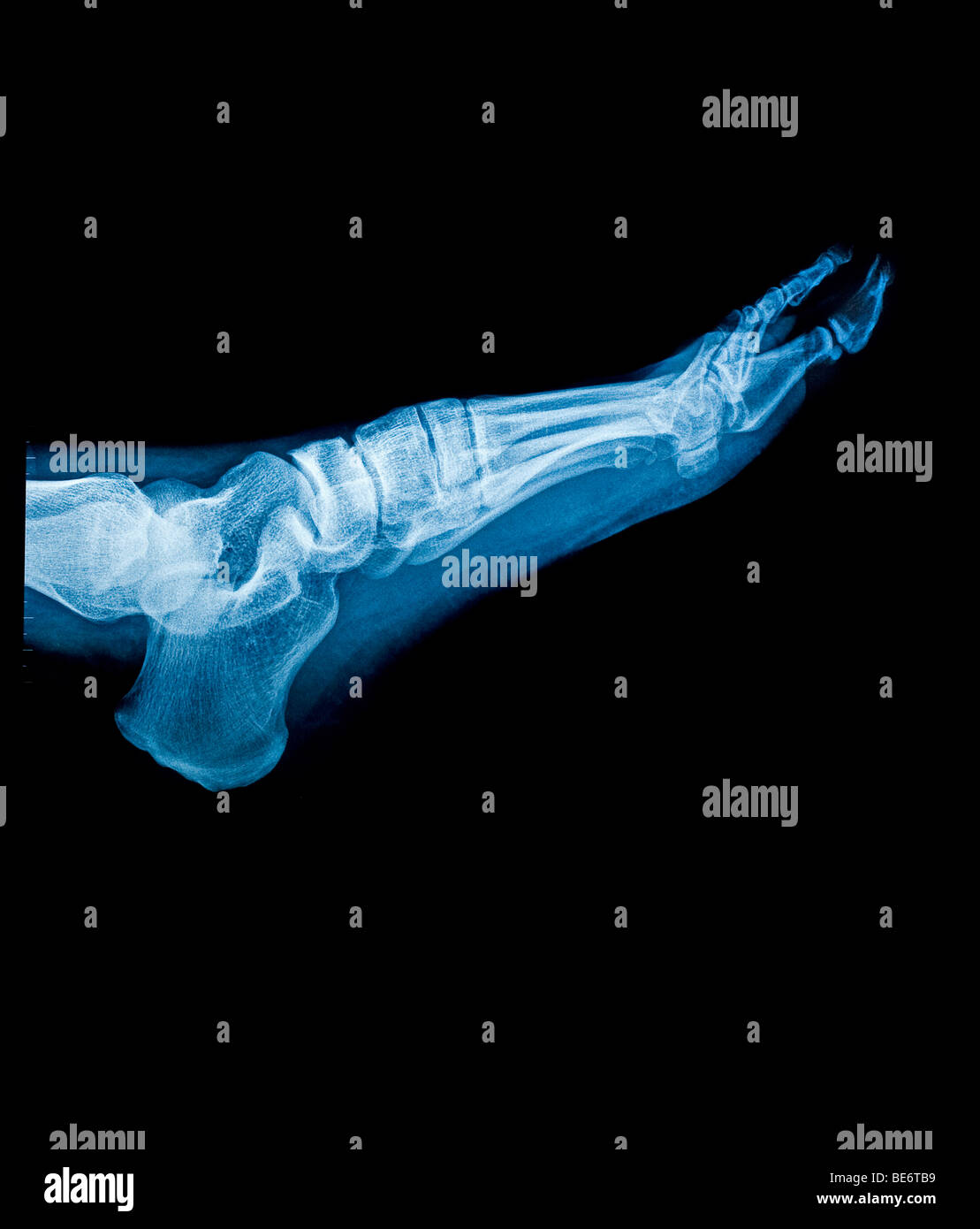 X-Ray des linken Fußes Stockfoto