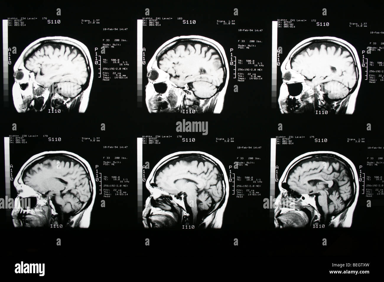MRI scan des Gehirn des Patienten mit und ohne Kontrastmittel Stockfoto