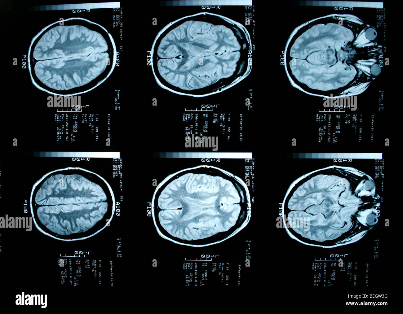MRI scan des Gehirn des Patienten mit und ohne Kontrastmittel Stockfoto