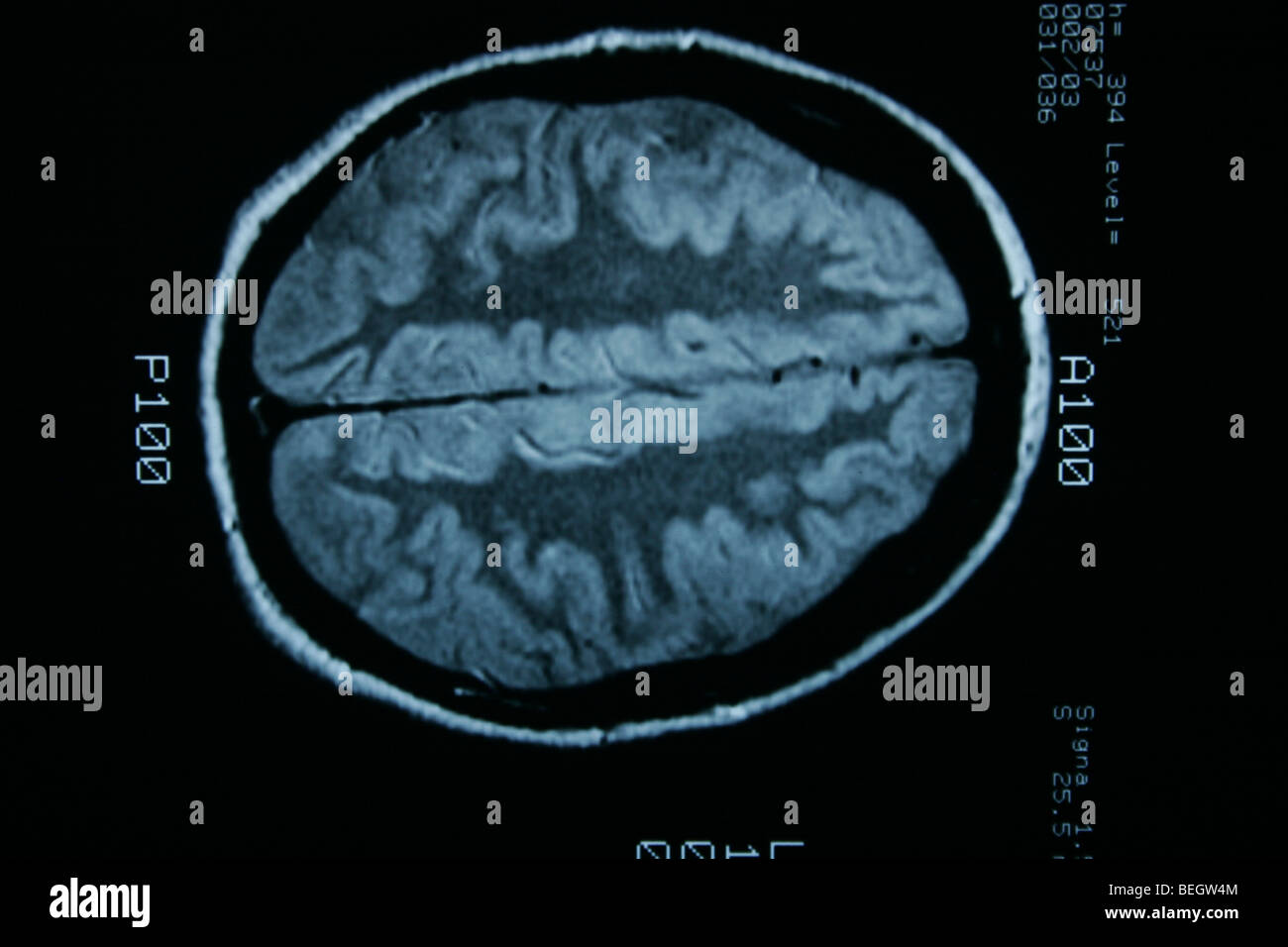 MRI scan des Gehirn des Patienten mit und ohne Kontrastmittel Stockfotografie Alamy