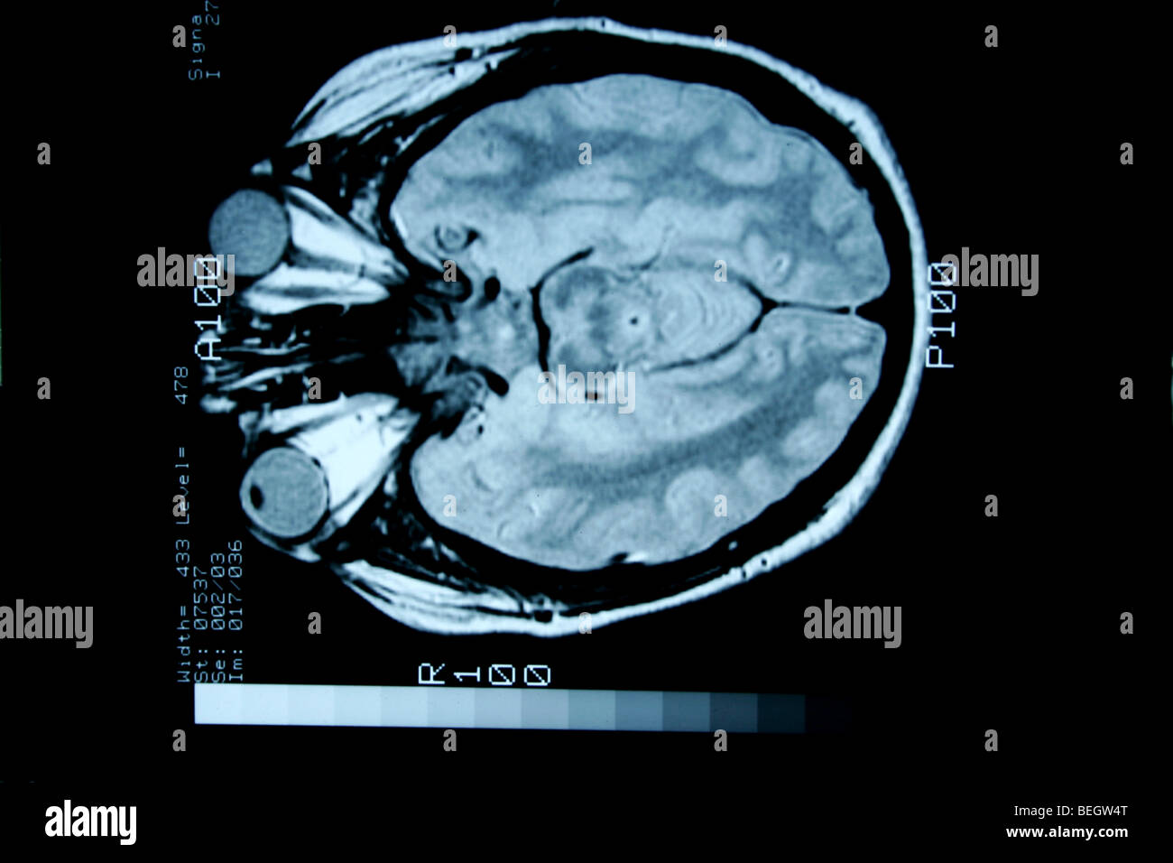 MRI scan des Gehirn des Patienten mit und ohne Kontrastmittel Stockfotografie Alamy