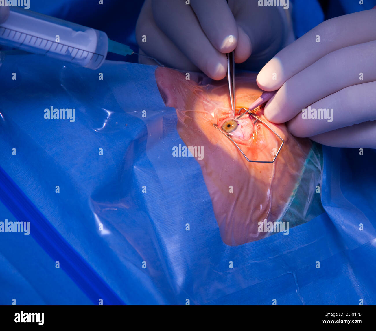 Augen-Operation - Linse zu implantieren Stockfoto