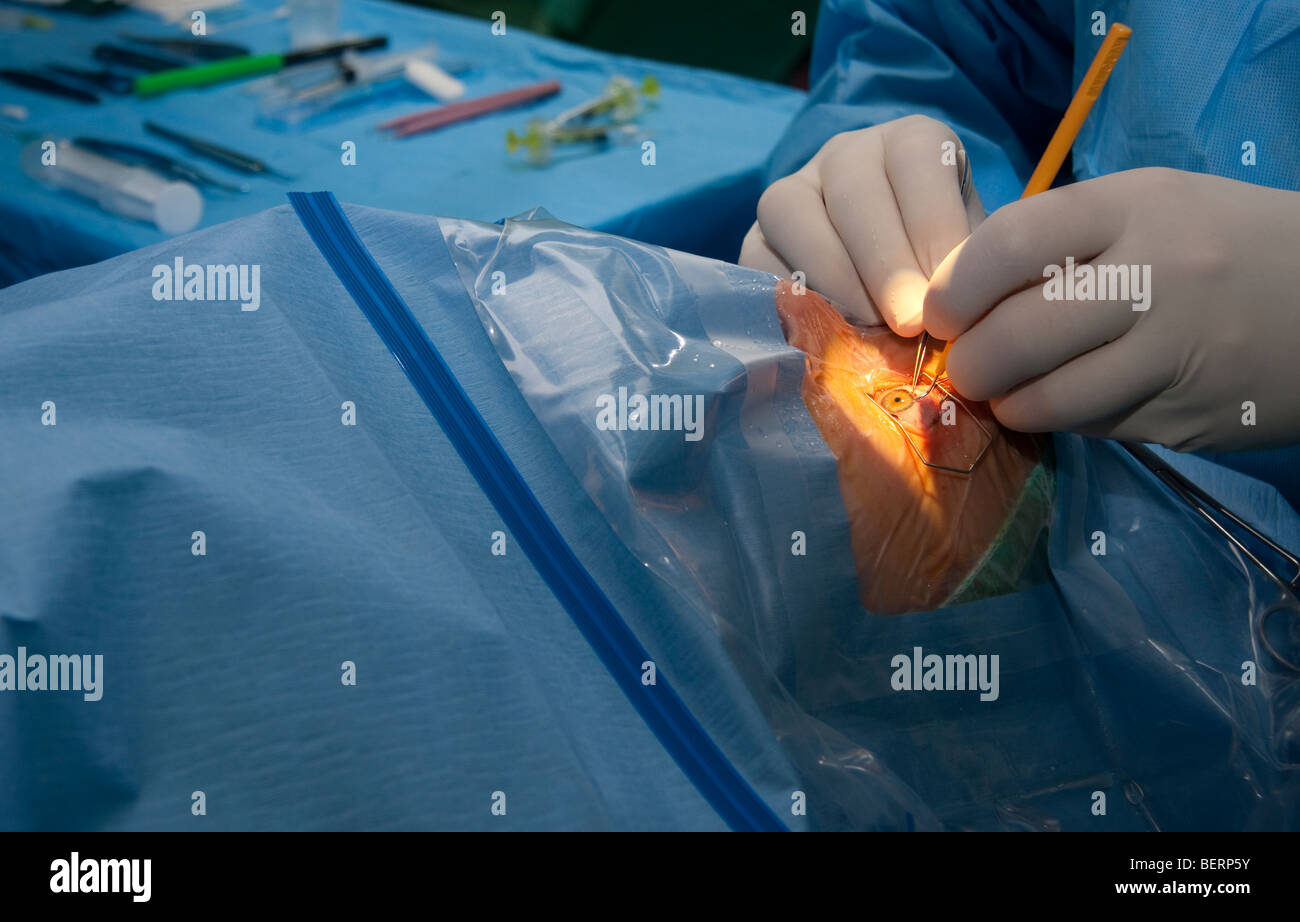 Augen-Operation - Linse zu implantieren Stockfoto