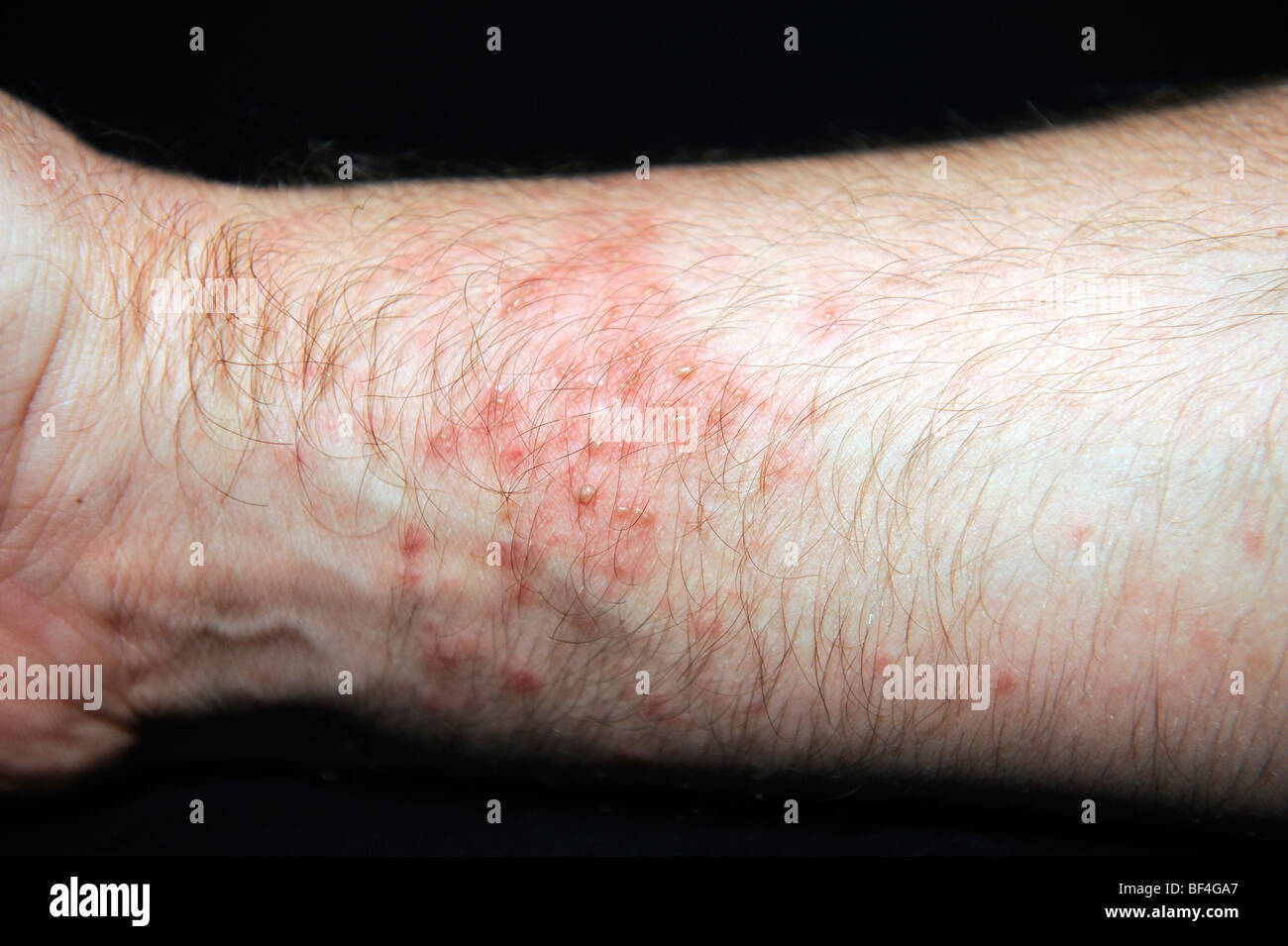 Sehr rot, Blasen Haut, Nesselsucht oder Urtikaria nach Kontakt mit Seeanemonen (Heteractis Spec.) Stockfoto
