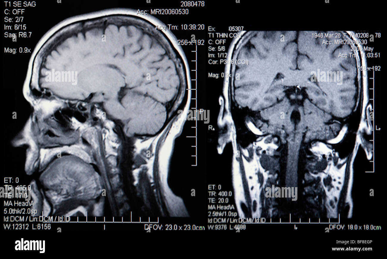 Dual-View Real MRI Scans von Kopf und Gehirn Stockfoto