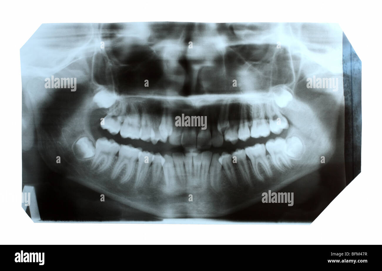 zahnärztliche Röntgenbild der Kiefer mit Zähnen Stockfoto