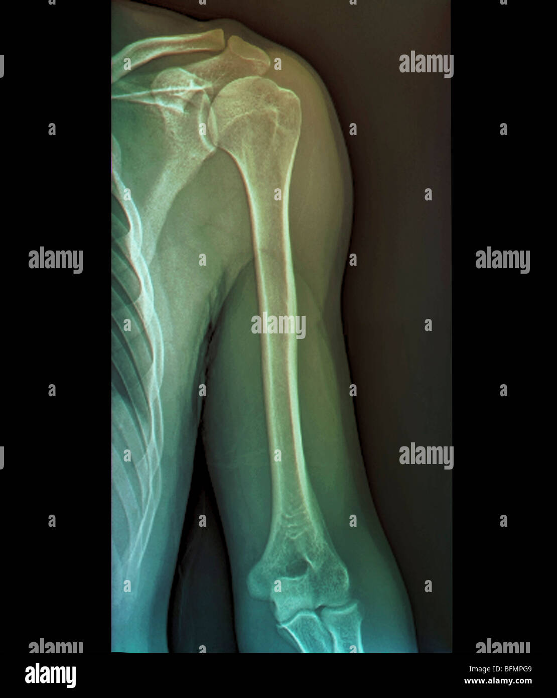 Normale Schultergelenk, x-ray Stockfoto