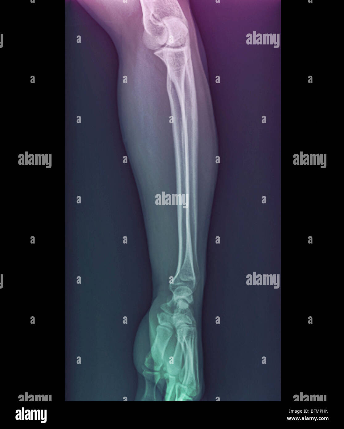 Normale Ellbogen und Handgelenk Gelenke, x-ray Stockfoto