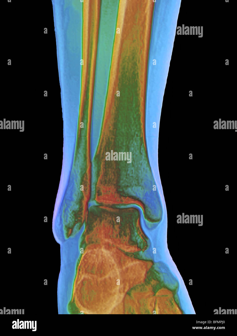 Normale Sprunggelenk, x-ray Stockfoto