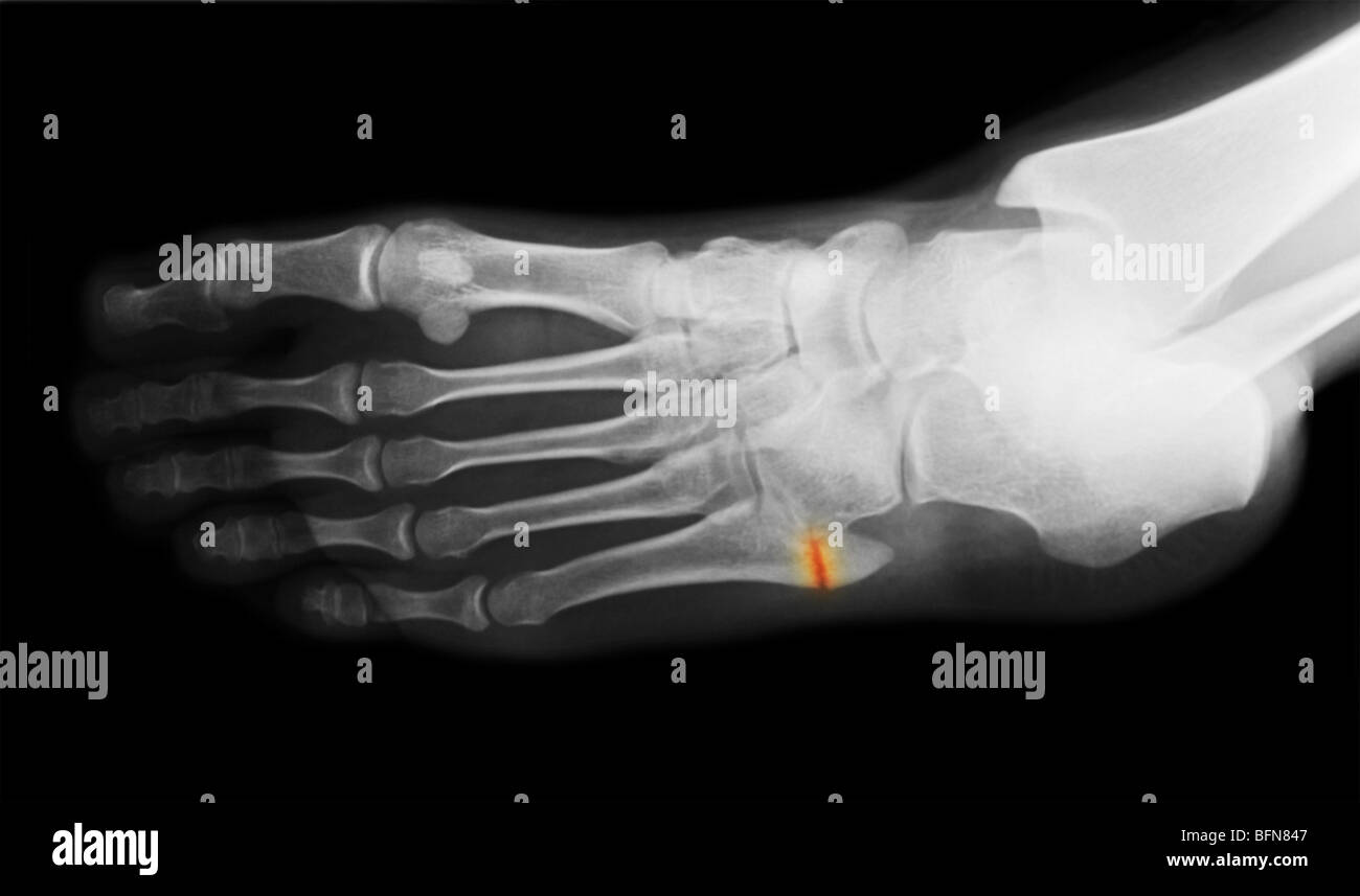 x-ray zeigt eine Fraktur an der Basis des fünften Mittelfußknochens des Fußes Stockfoto