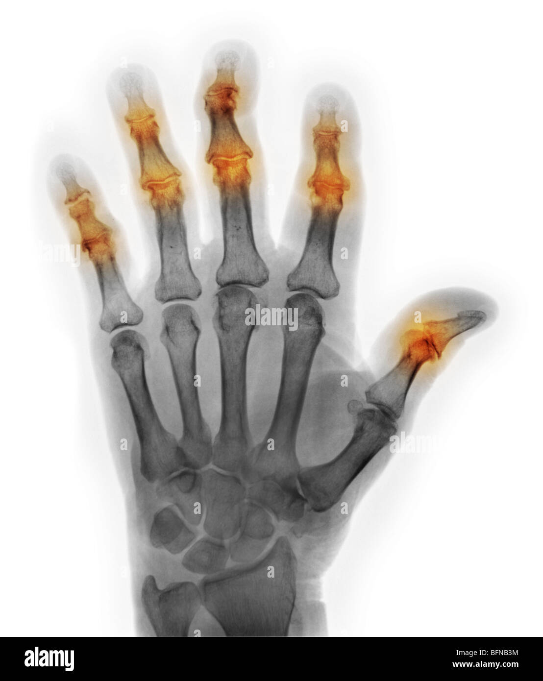 Hand Röntgen eines 85 Jahre alten Mannes mit Arthrose Stockfoto