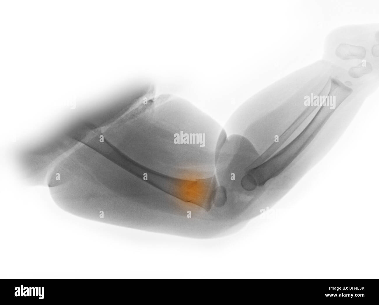 Röntgen des Beines ein 8 Monate altes Mädchen zeigt eine Femur Fraktur Stockfoto