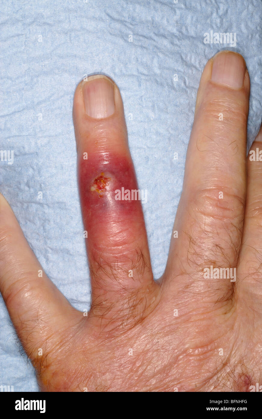 MRSA Staphylokokken-Infektion auf dem Ringfinger der ein 79 Jahre alter Mann mit einer Geschichte von diabetes Stockfoto