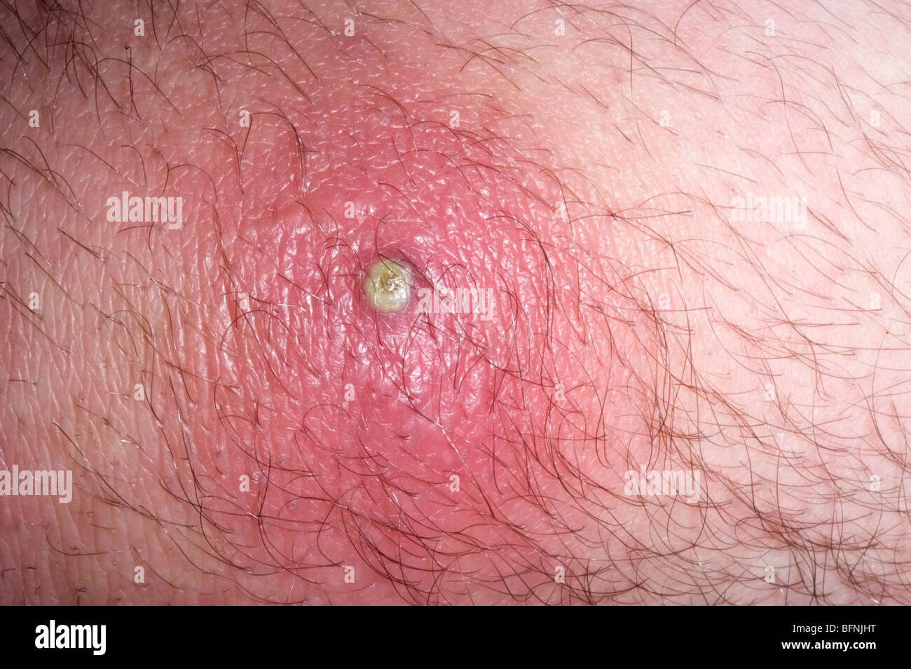 Methicillin-resistenten Staph Aureus (MRSA) Hautinfektion in ein 26 Jahre alter Mann Stockfoto