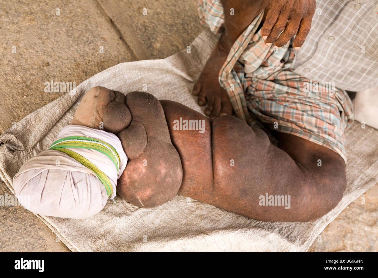 Die aufgeblähten Bein eines indischen Mannes Elephantiasis leiden. Stockfoto