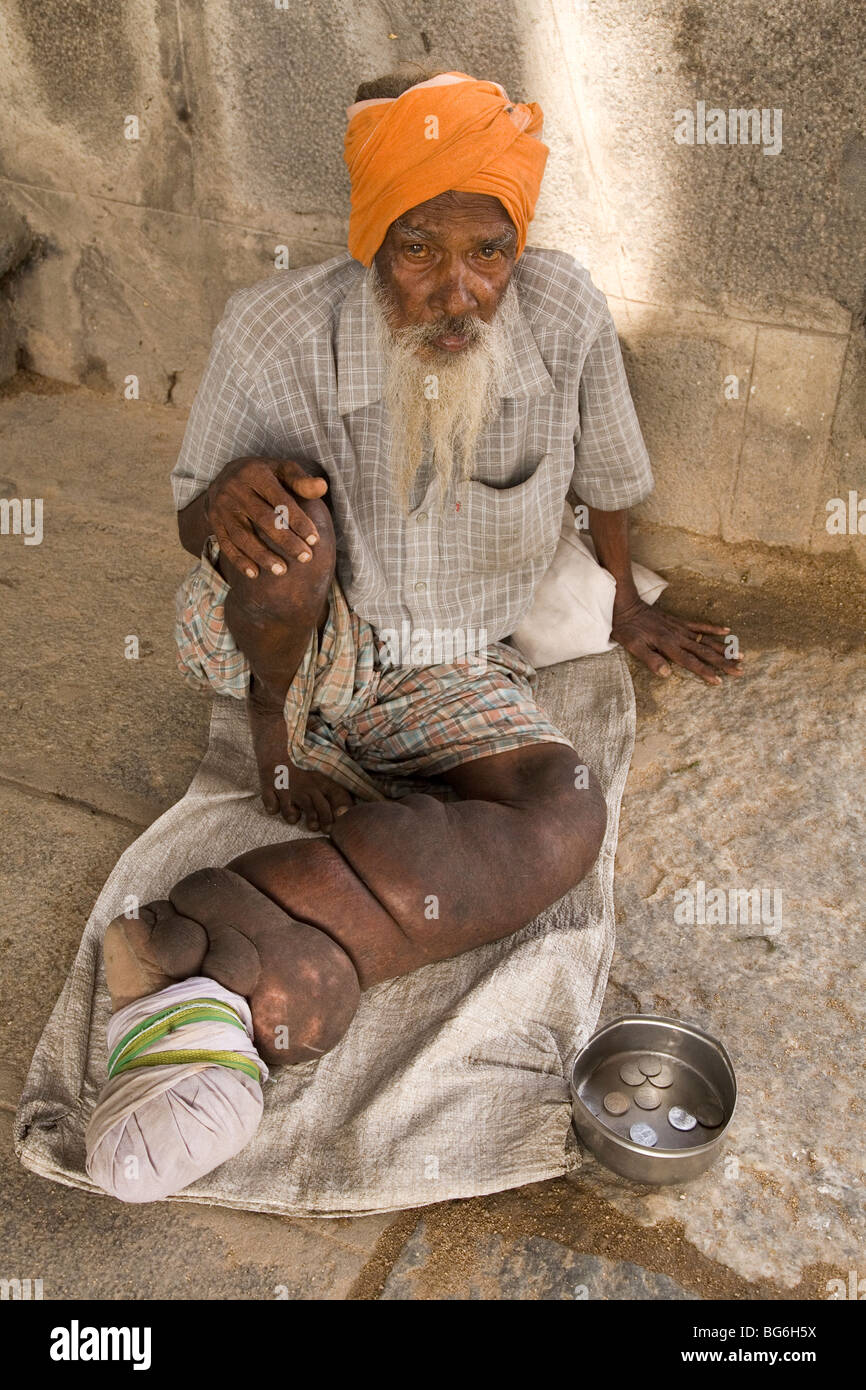Ein indischer Mann Elephantiasis leiden hat einen aufgeblähten Bein. Er lebt vom betteln. Stockfoto