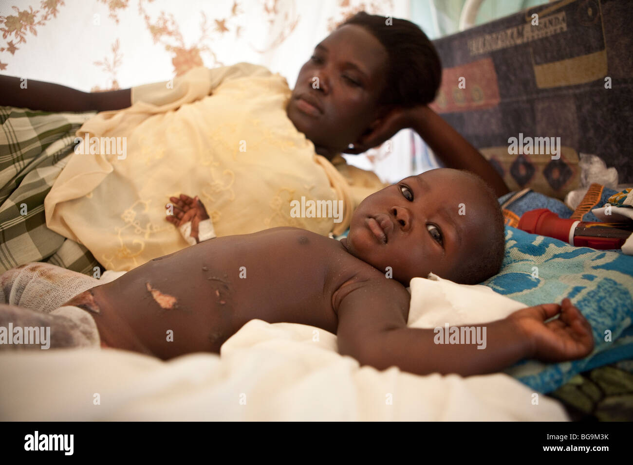 Eine Frau kümmert sich um ihr kleines Mädchen leiden brennt in Amuria "Gesundheit Mitte, nordöstlichen Uganda, Ostafrika. Stockfoto