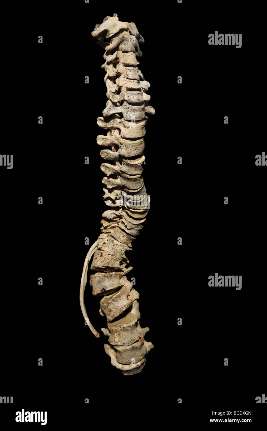 Skoliose, Verkrümmung der Wirbelsäule Stockfoto