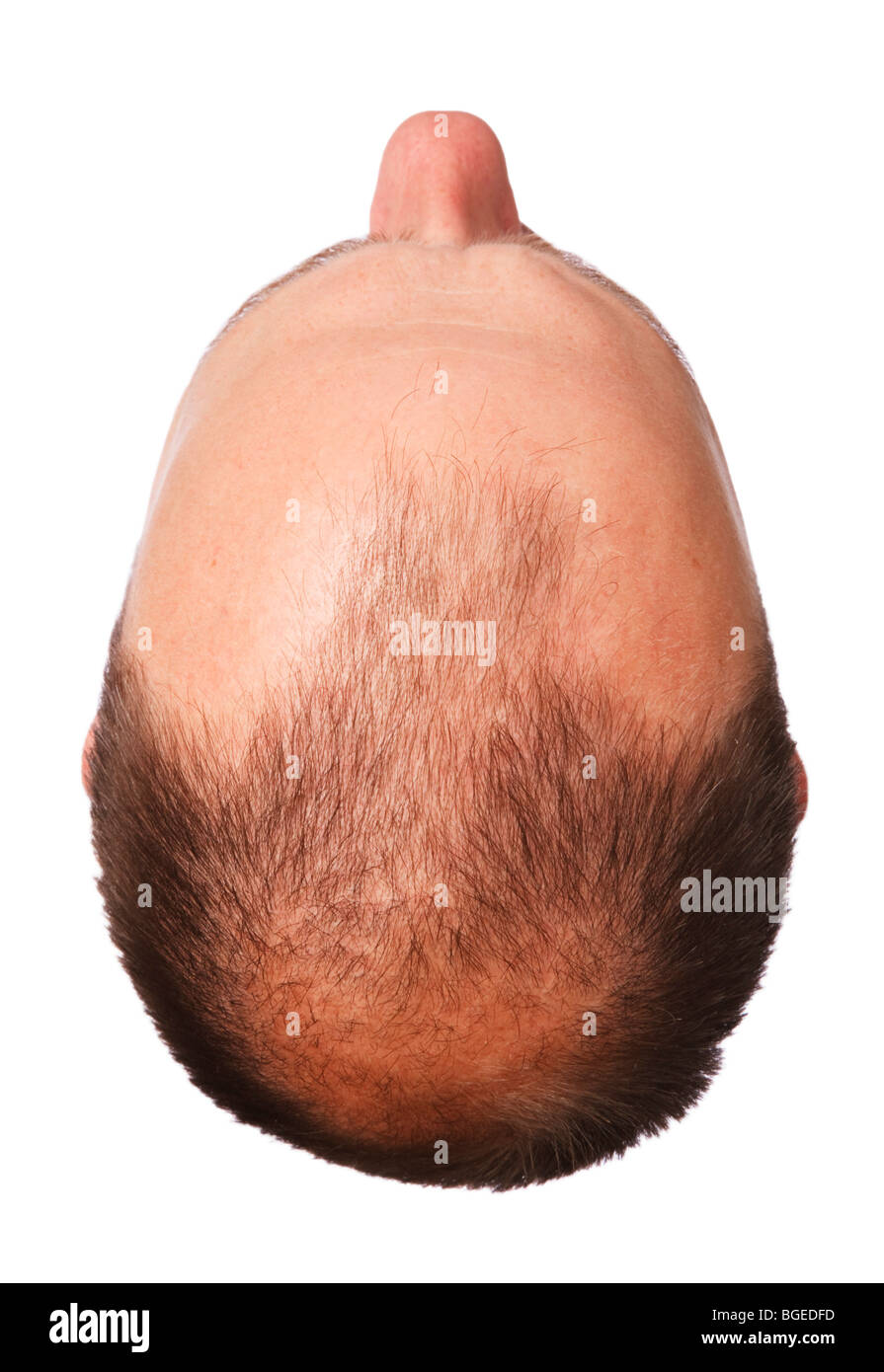Kopf eines Mannes mit männlichen Haarausfall, isoliert auf weißem Hintergrund Stockfoto