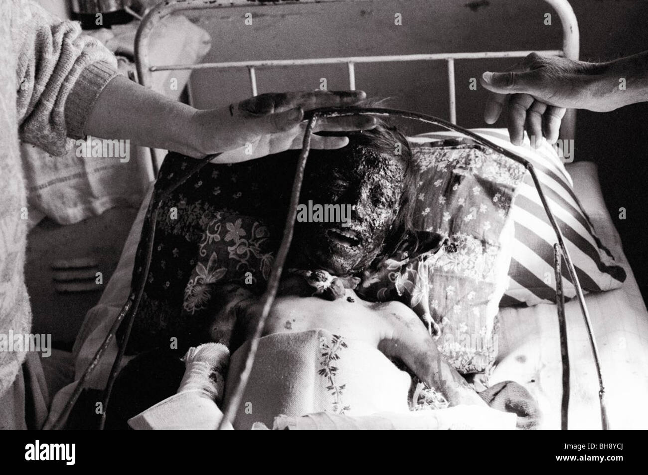 Kind im Krankenhaus in Kabul Indira Gandhi brannte während des Spielens mit Landminen. circa 1994 Stockfoto