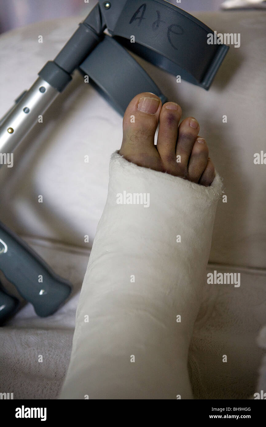 Gebrochenes Bein mit einem Gipsverband ruht, erhöht auf einem Sofa mit