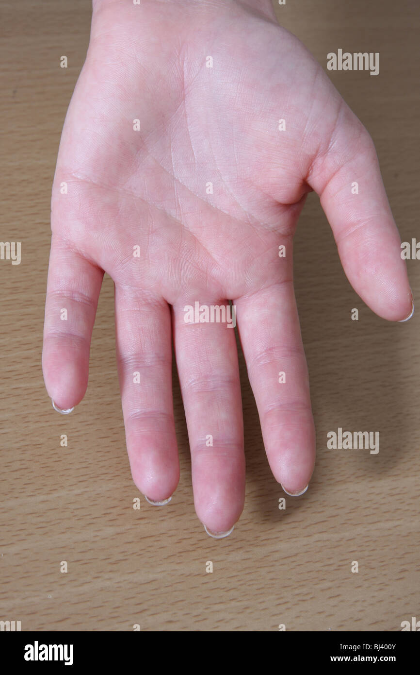Handfläche weiße flecken Weiße Flecken