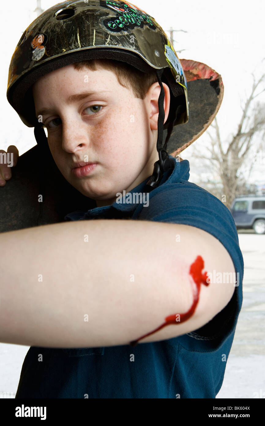 Junge hält eine Skateboard und zeigt seine verletzten Ellenbogen Stockfoto