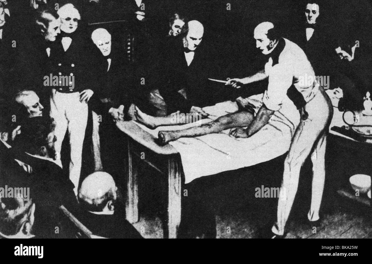 Medizin, Chirurgie, Amputation eines Oberschenkels, Apothecär Peter Squire, Chirurg Robert Liston und Joseph Lister, 19. Jahrhundert, historisch, historisch, Apotheker, Dispensierchemiker, Drogist, Apothekarien, Apotheker, Dispensierchemiker, Drogisten, Operation, antiseptisch, sauber, steril, germfrei, Publikum, Gesundheit, Menschen, Stockfoto