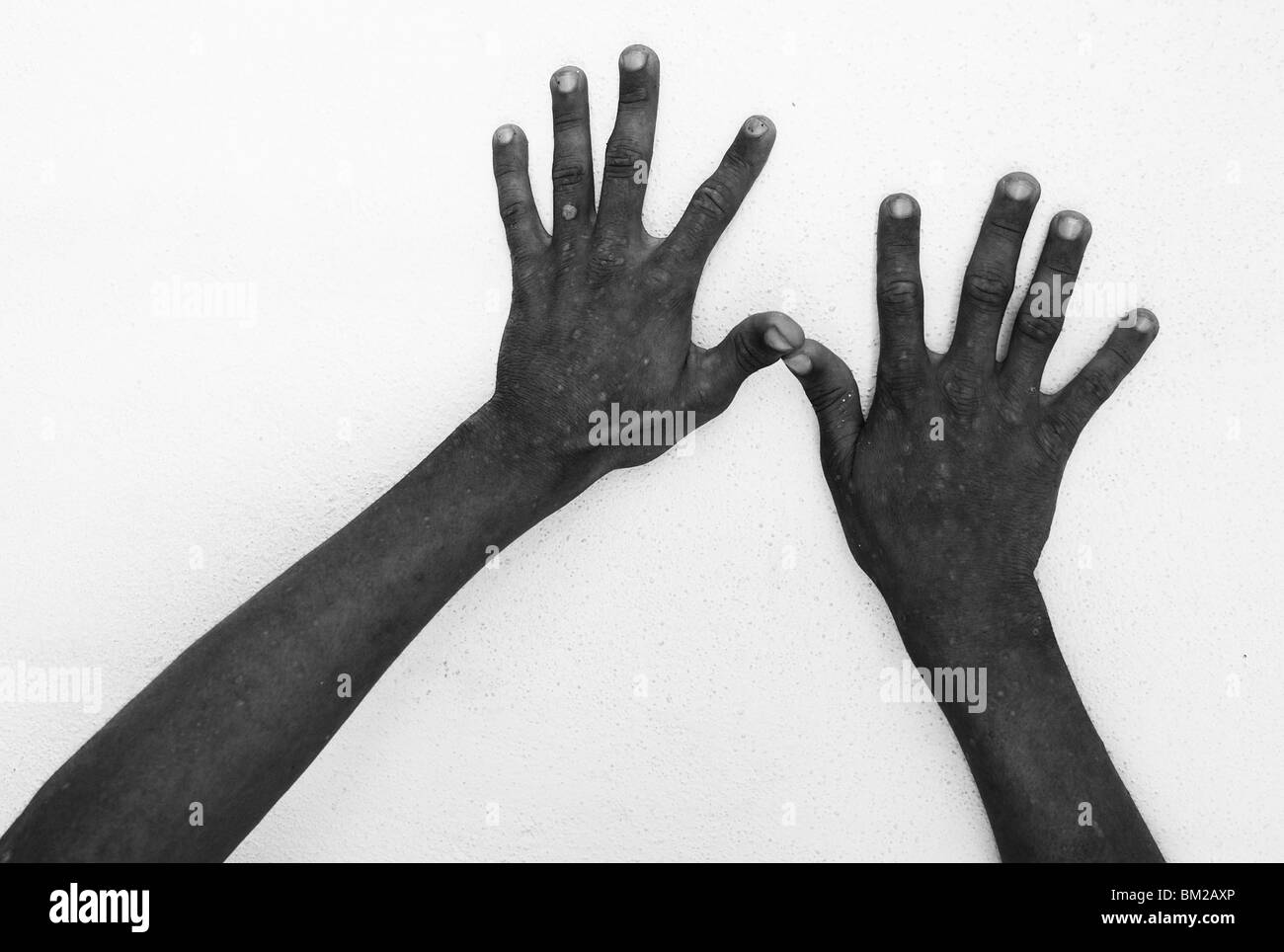 Hände eines HIV positiven Teenagers in Roatan, Honduras. Stockfoto