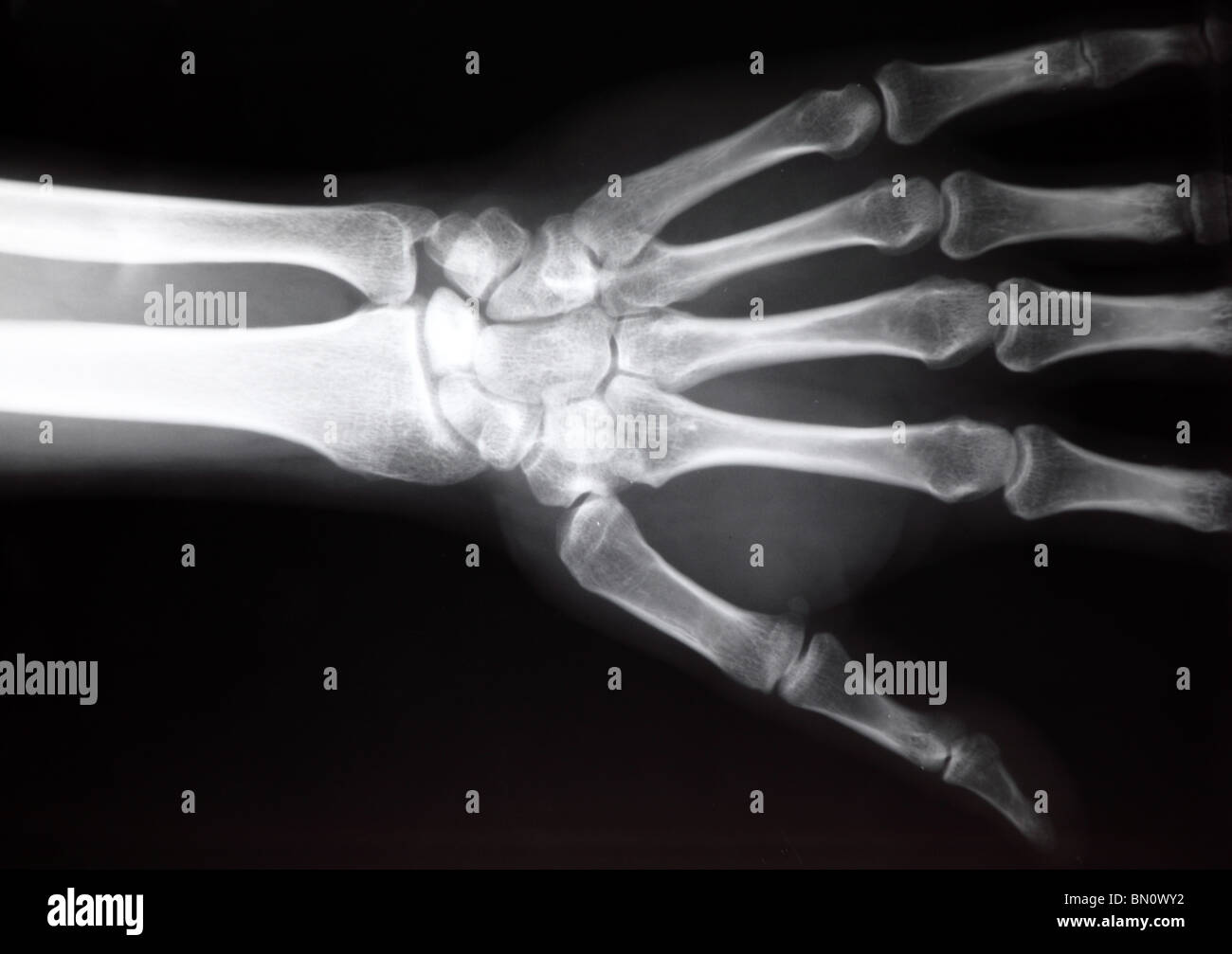 Hand Röntgen Bild medizinischen Hintergrund Stockfoto