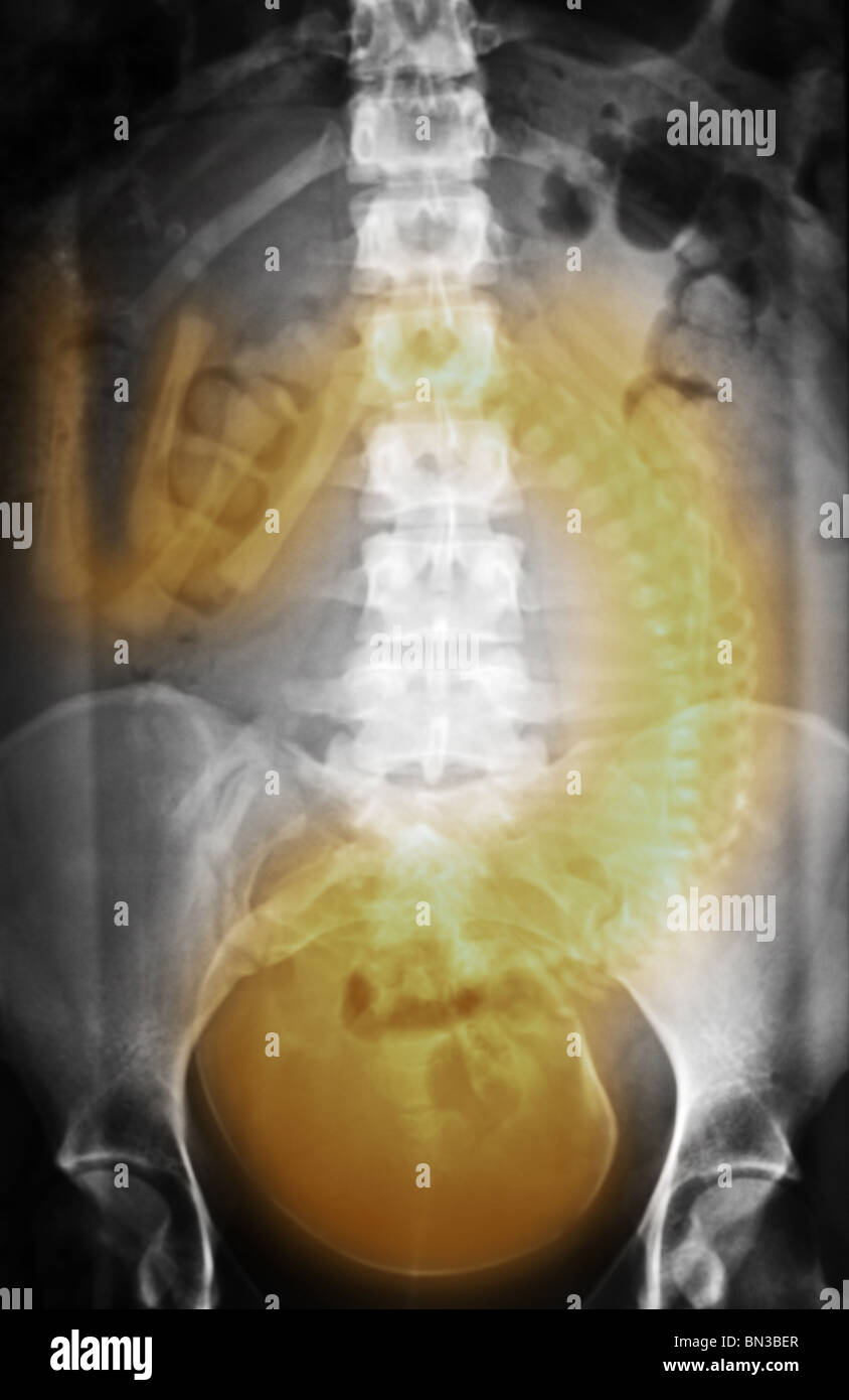 Abdominale Röntgenbild eine 19 Jahre alte Frau mit einem voll ausgetragenen Fötus Stockfoto