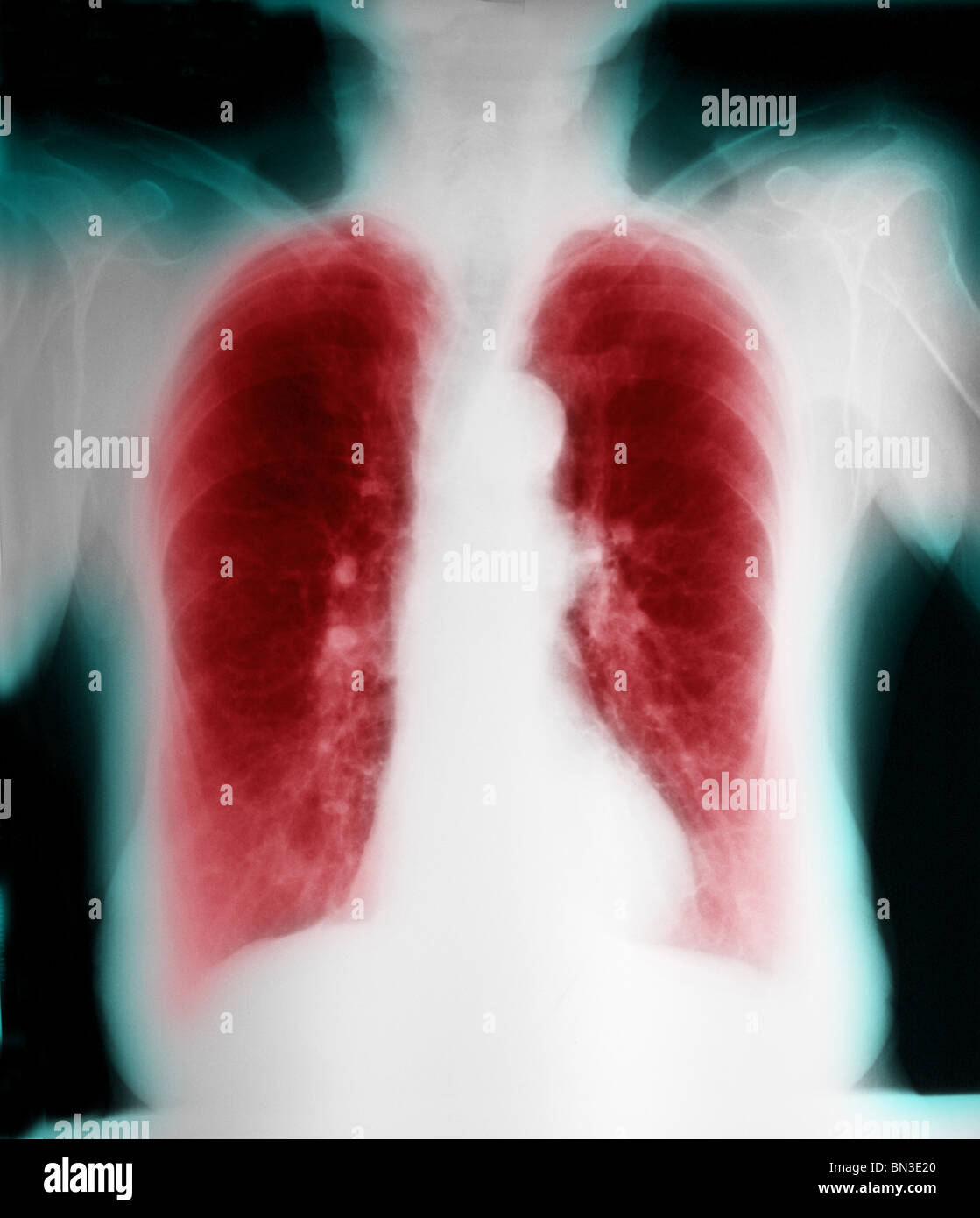 Röntgenaufnahme des älteren 79 Jahre alte weibliche Raucher mit chronisch obstruktiver Lungenerkrankung (COPD) Stockfoto