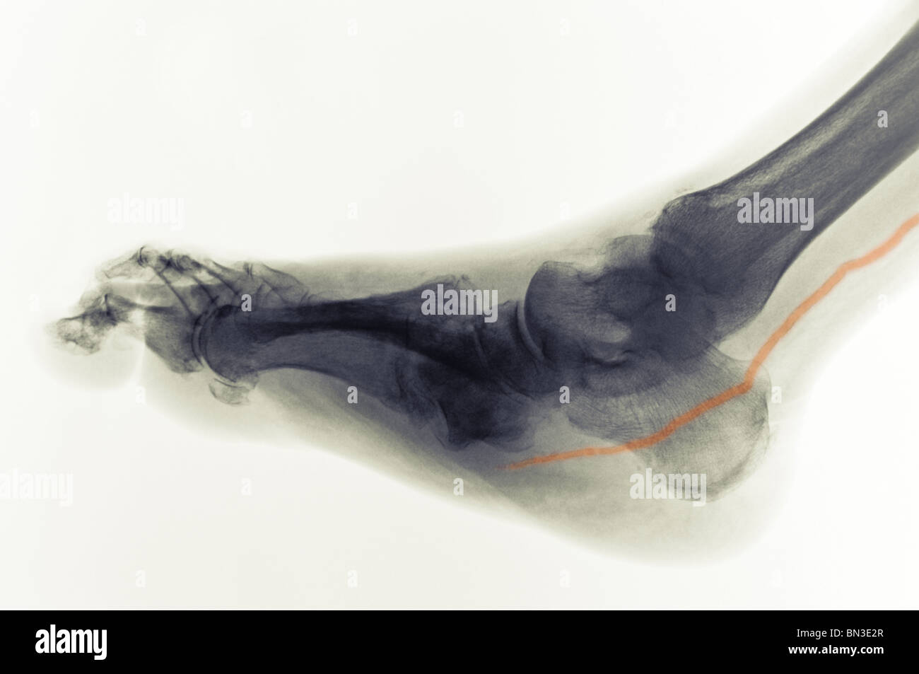 eingefärbte Röntgen des Fußes eines Menschen mit Diabetes, eine verkalkte Arterie hat Stockfoto